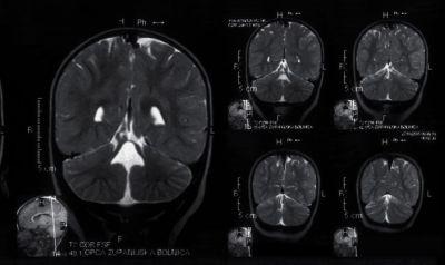 MRI w chorobie Huntingtona