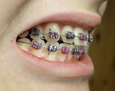 Dental braces, fot. Autor MAKY.OREL (Praca własna) [CC BY-SA 3.0