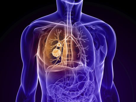 New therapies for non-small cell lung cancer