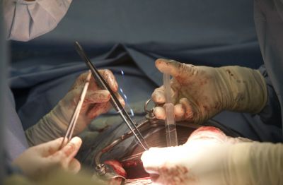 Preventing organ rejection after transplantation